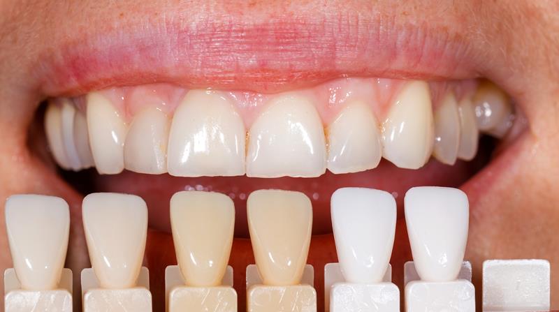 Veneers in Durham, NC